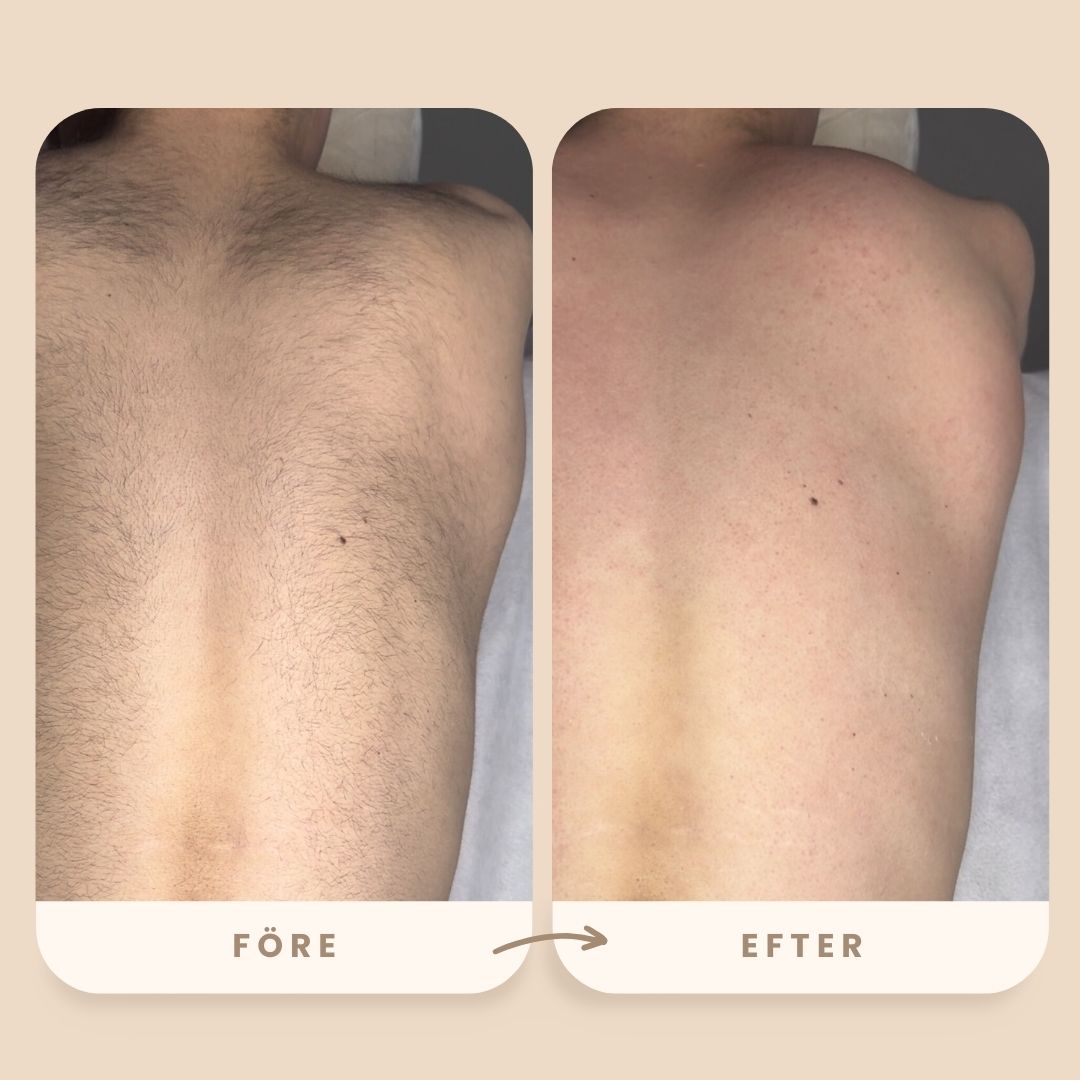 Bodysugaring även brasiliansk.